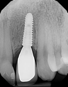 X-Ray of a dental implant